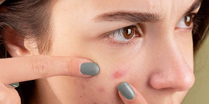 7 savjeta kako se riješiti prištića na licu