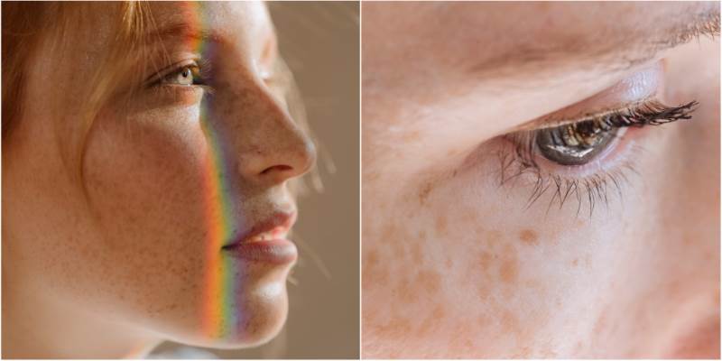 Kako se riješiti pigmentnih mrlja na licu?